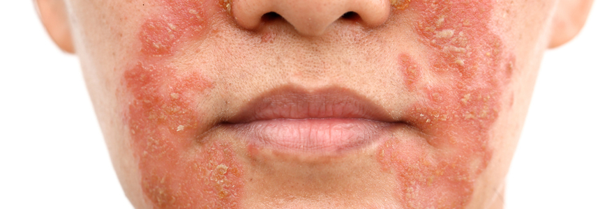 psoriasis du visage